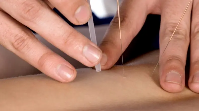 طب سوزنی در محل